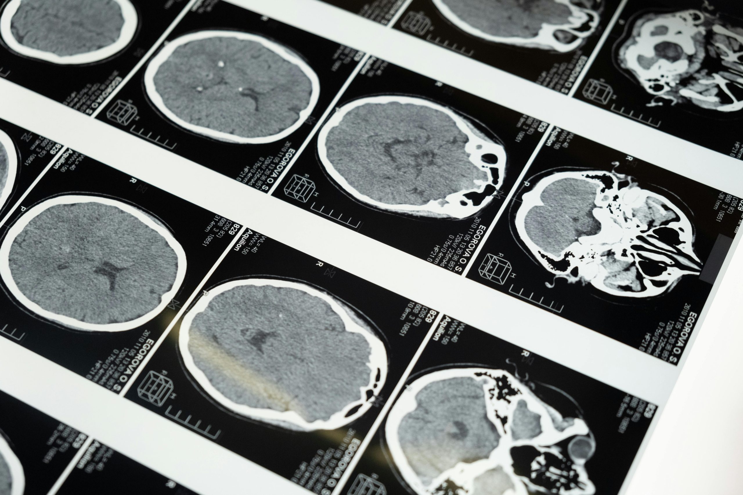 The Digital Mirror: How Social Media Shapes Our Body Image and Mental Health Detailed brain MRI scans displayed on a lightbox, showcasing medical imaging techniques.