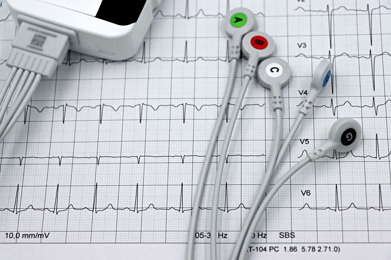 PHP and IOP for Dual Diagnosis Addiction Recovery Close-up of ECG monitor leads on a printed cardiogram, showcasing heart health diagnostics.